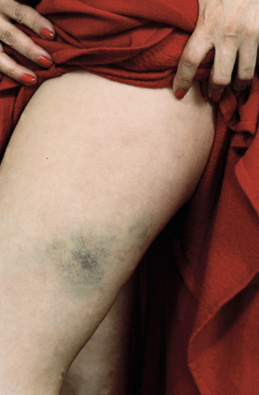 Susan-Meiselas_Bruised-woman-who-was-a-victim-of-domestic-violence
